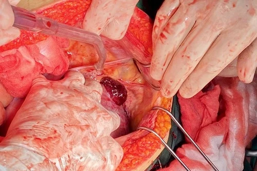 Hà Nội: “Báo động đỏ” toàn viện cứu sống thần kỳ sản phụ vỡ thai, chảy máu ồ ạt