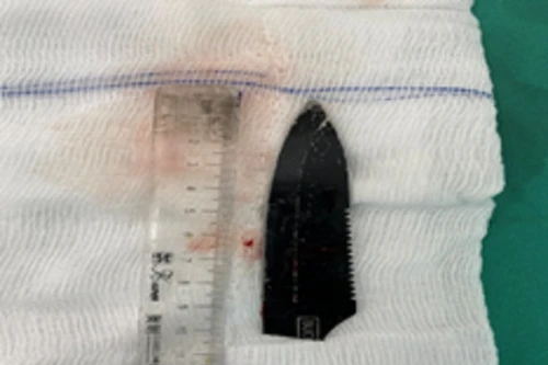 Nam thanh niên bị đâm dao xuyên bả vai được cứu sống kịp thời