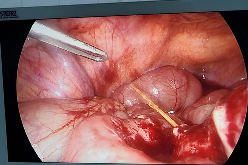 Cấp cứu người đàn ông 57 tuổi bị tăm nhọn đâm thủng ruột