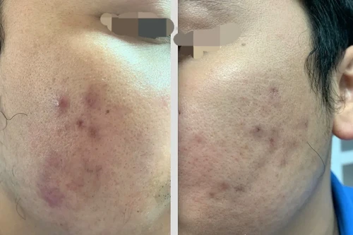 Đi tiêm meso căng sáng da mặt để đẹp trai hơn, nam thanh niên ở Hà Nội phải nhập viện