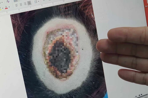 Cô gái nhập viện vì viêm loét, hoại tử vùng đỉnh đầu do hóa chất tẩy màu tóc