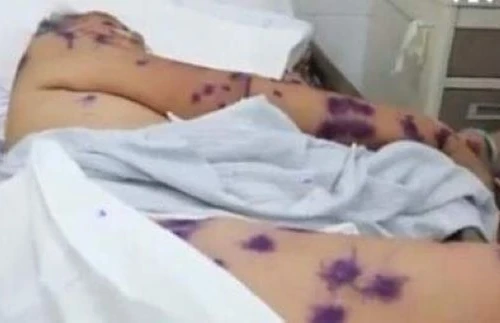 Cấp cứu hai trường hợp bị ong đốt hàng trăm nốt chi chít khắp cơ thể