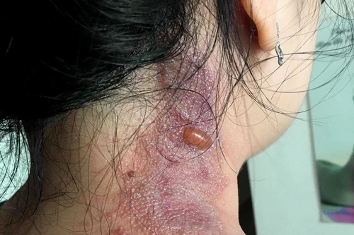 Hàng chục bệnh nhân đến viện do kiến ba khoang đốt dù không phải mùa cao điểm