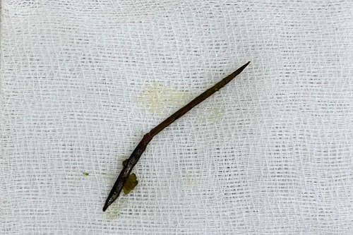 Nam thanh niên thủng ruột non do nuốt phải dị vật khi ăn lẩu