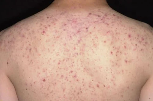 Trị mụn trứng cá ở lưng tại Spa, nữ bệnh nhân 36 tuổi bị sốc phản vệ suýt tử vong