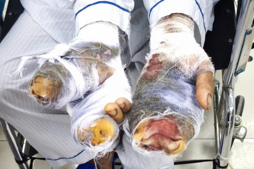 Chủ nhà bị chó Becgie nặng gần 30kg tấn công, phải nhập viện cấp cứu