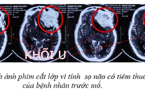 Mổ lấy khối u não lớn để cứu thai phụ 22 tuần tuổi mà vẫn giữ được thai