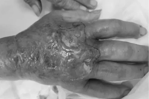 Chín người bị rắn độc cắn do thu dọn đồ đạc, kiểm tra sân vườn sau bão lũ