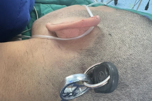 Cấp cứu nam thanh niên bị chìa khóa cắm sâu vào đầu