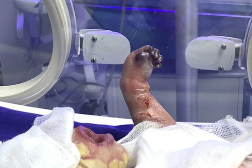 Gửi phân tích mẫu gen của bé sơ sinh mắc bệnh “da vảy cá” cực hiếm gặp ở Hà Giang