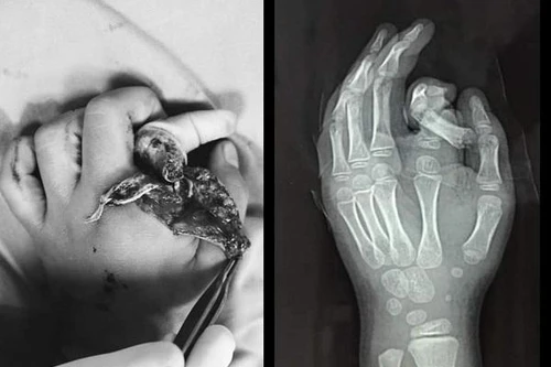 Hà Nội: Đưa tay vào máy giặt đang chạy, bé trai 6 tuổi bị tai nạn nghiêm trọng