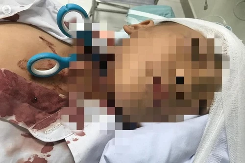 Cứu sống cháu bé 7 tuổi bị 2 lưỡi kéo đâm xuyên cổ vào tận đốt sống