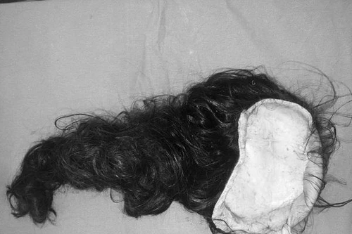 Bé gái 8 tuổi bị lột hoàn toàn da đầu, lộ cả xương sọ do tóc cuốn vào xe 3 bánh