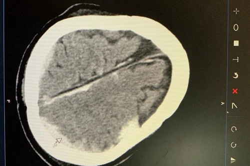 Cứu sống bệnh nhân bị tai nạn giao thông gây dập não, đa chấn thương phức tạp