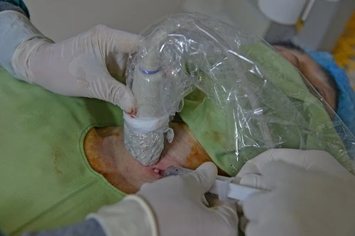 Tiêm cồn tuyệt đối để điều trị nang giáp cho người đàn ông đã chọc hút dịch 30 lần