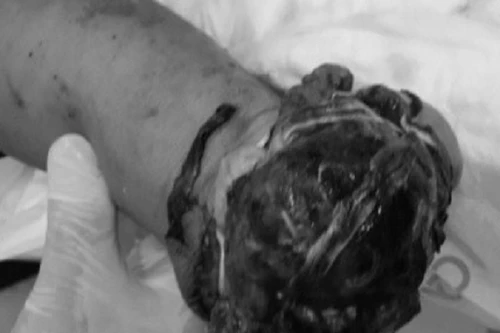 Nam thanh niên chấn thương sọ não, cụt bàn tay phải do nấu ăn bằng bếp ga mini