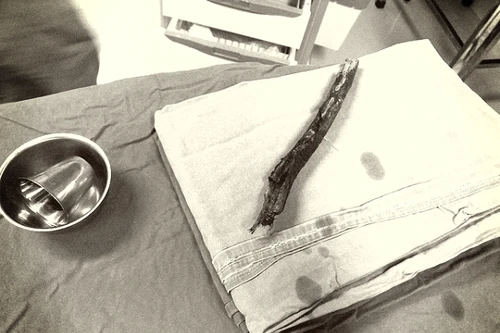 Uống rượu say đi xe máy, nam thanh niên bị cành cây đâm xuyên vùng mặt