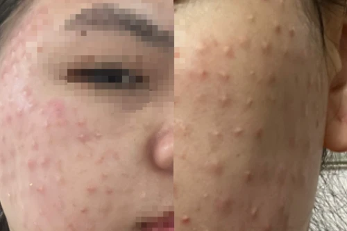 Tiêm chất làm trắng da siêu tốc, cô gái nhập viện với gương mặt chi chít mụn sần