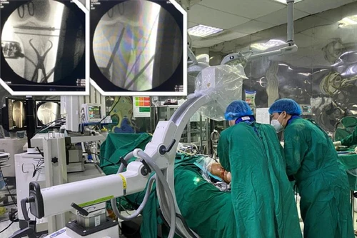 Cấp cứu thành công bệnh nhân chấn thương sọ não, gãy kín mâm chày