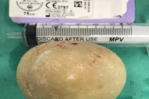 Choáng váng: Lấy ra viên sỏi thận khổng lồ nặng gần nửa cân từ người bệnh 61 tuổi