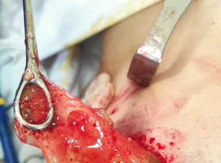 Đặt túi silicon nâng ngực loại “xịn” nhưng vẫn phải nhập viện cầu cứu bác sĩ