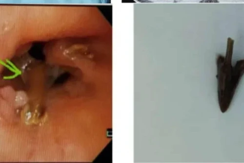 Bị sặc khi ăn thịt gà, người đàn ông phải nhập viện