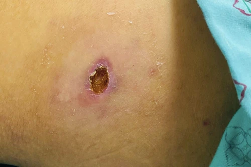 Gần 300 người ở Yên Bái mắc bệnh sốt mò, 1 ca tử vong