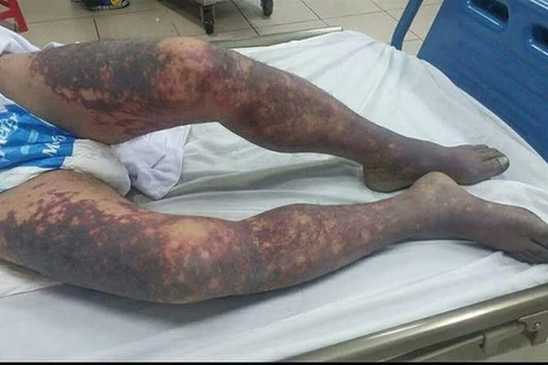 Người đàn ông 50 tuổi tử vong chỉ hơn 1 ngày sau khi giết lợn ăn tất niên 