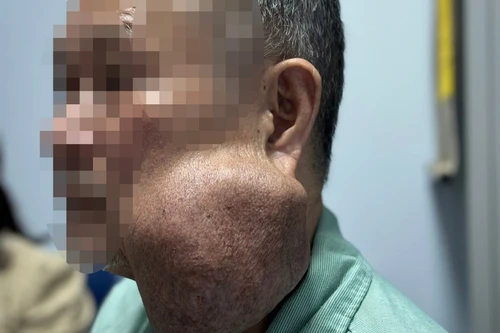 Có u khổng lồ dưới hàm 30 năm không điều trị, người đàn ông suýt bị đe dọa tính mạng