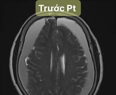 Khoan sọ hút máu tụ dưới màng cứng hai bên bán cầu cứu sống cụ bà 82 tuổi ở Hà Nội