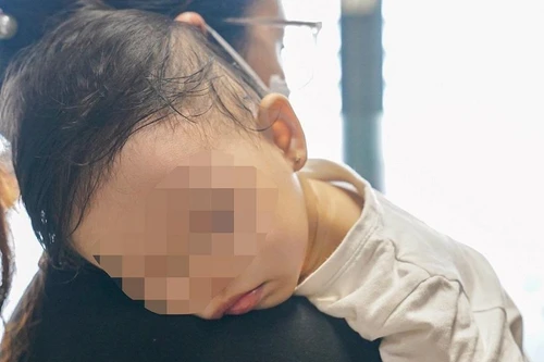 Sơ ý để mẩu dây thép rơi vào nồi cháo nấu cho trẻ, bé 13 tháng tuổi thủng amidan