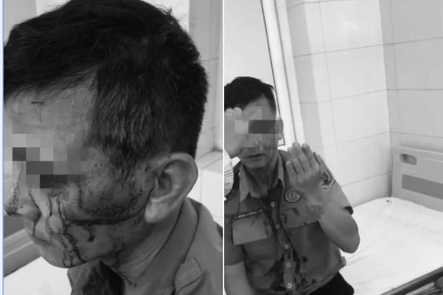 Nhân viên bảo vệ Bệnh viện K bị đối tượng chèo kéo người bệnh hành hung, khâu 8 mũi