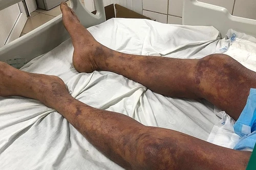 Nam bệnh nhân xuất huyết hoại tử tím đen toàn thân, suy đa tạng do ăn thịt lợn ốm