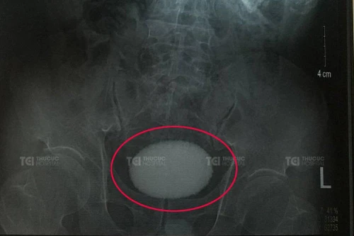 Hiếm gặp: Bóc viên sỏi kích thước khủng, to tròn như quả trứng vịt nằm trong bàng quang