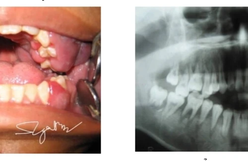 Đi khám viêm lợi, nam sinh 16 tuổi được phát hiện ung thư máu