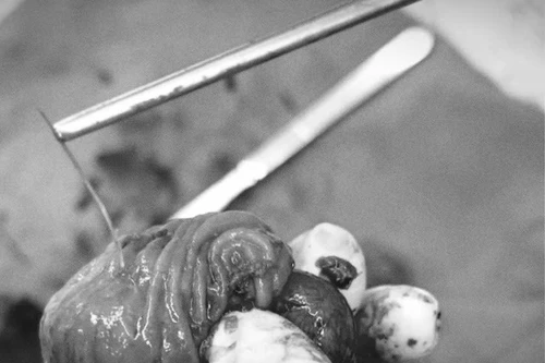 Sau ăn bún cá, nam thanh niên bị mảnh xương cá đâm thủng ruột non