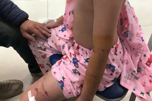 Hà Nội: Bé trai 10 tuổi bị chó cắn nhập viện khi đi chúc Tết