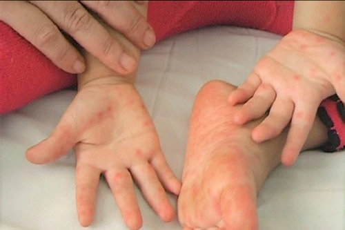 Lo ngại dịch tay chân miệng tăng đầu năm học, trẻ bị bệnh phải cách ly 10 ngày