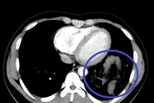 Tưởng hậu Covid-19, bệnh nhân đến viện khám mới biết bị vỡ cơ hoành