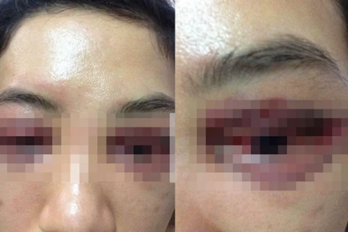 Cô gái 20 tuổi hỏng mắt sau cắt mí tại một Spa