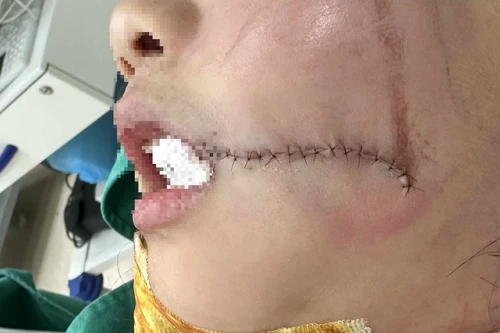 Liên tục cấp cứu người lớn, trẻ em vỡ xương hàm, gãy răng do tai nạn thang máy