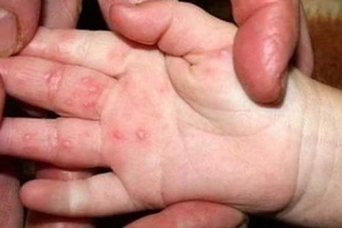Số mắc tay chân miệng trên cả nước tăng hơn 4 lần, Hà Nội ghi nhận hơn 80 ca