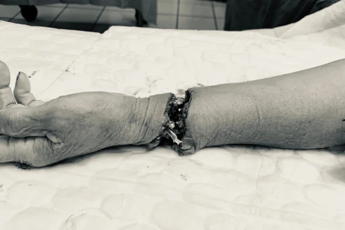 Nữ bệnh nhân 74 tuổi tự cắt đứt lìa cổ bàn tay trái, được cấp cứu và nối tay kịp thời