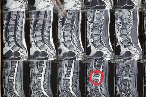 Nhiều bệnh nhân bị lún, xẹp đốt sống được điều trị hiệu quả bằng... bơm xi măng 