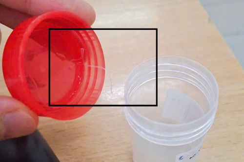 Hiếm gặp: Phát hiện ký sinh trùng trong mắt của một bệnh nhân