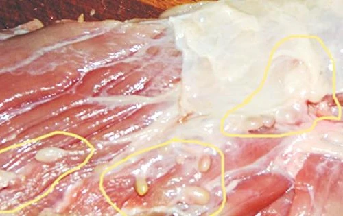 Hay ăn thịt bò tái, rau sống, một phụ nữ ở Hà Nội nhập viện vì mắc sán dây