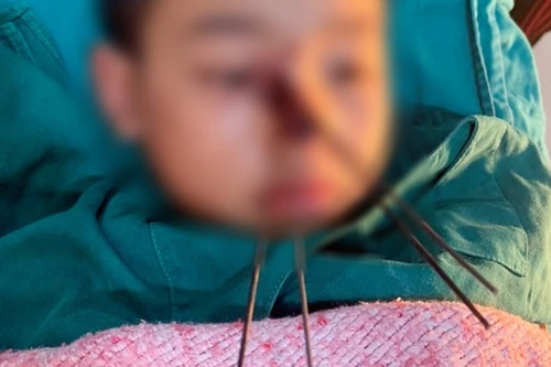 Bé trai 11 tuổi bị 4 mũi tên sắt từ nỏ tự chế bắn găm sâu vào vùng mũi