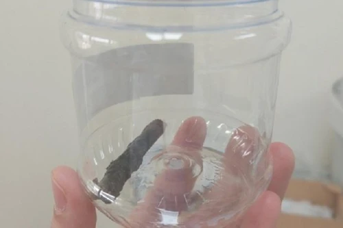 Nam thanh niên chung sống với cành cây dài gần 7cm đâm xuyên phổi suốt 14 năm