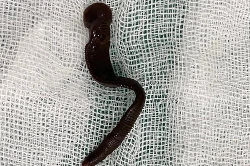 Gắp ra con đỉa to gần bằng ngón tay, sống suốt 1 tháng trong khí quản bệnh nhi