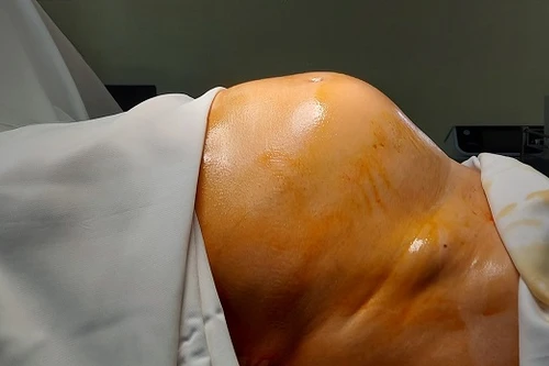 64 tuổi mới lần đầu đi viện, người phụ nữ ở Hà Nội bụng to phình như bầu sắp đẻ